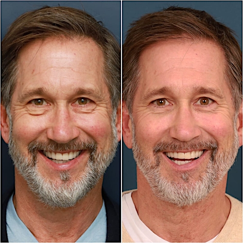 Blepharoplasty Before & After Gallery - Patient 58242479 - Image 3