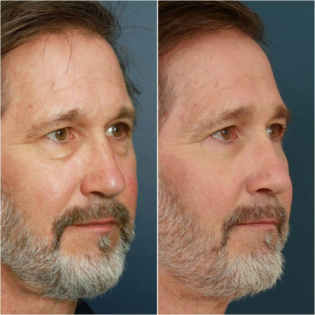 Blepharoplasty Before & After Gallery - Patient 58242479 - Image 4