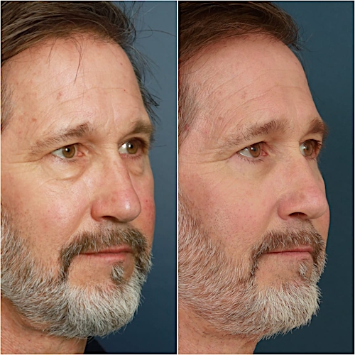 Blepharoplasty Before & After Gallery - Patient 58242479 - Image 4