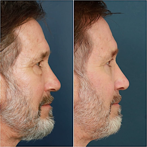Blepharoplasty Before & After Gallery - Patient 58242479 - Image 5