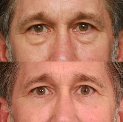 Blepharoplasty Before & After Gallery - Patient 58242479 - Image 1