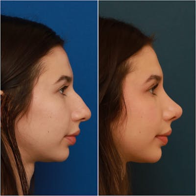 Rhinoplasty Before & After Gallery - Patient 58242488 - Image 1