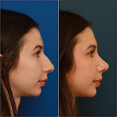 Rhinoplasty Before & After Gallery - Patient 58242488 - Image 1