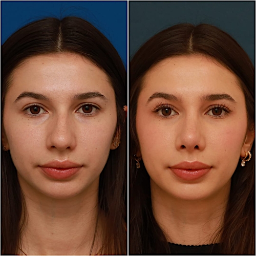 Rhinoplasty Before & After Gallery - Patient 58242488 - Image 2