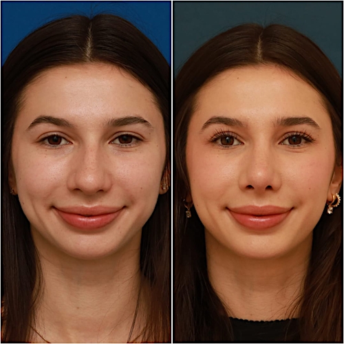 Rhinoplasty Before & After Gallery - Patient 58242488 - Image 3