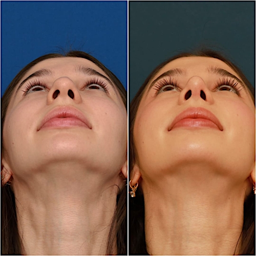 Rhinoplasty Before & After Gallery - Patient 58242488 - Image 4