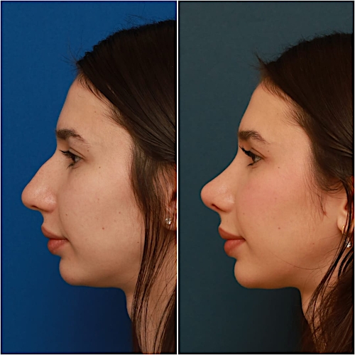 Rhinoplasty Before & After Gallery - Patient 58242488 - Image 5
