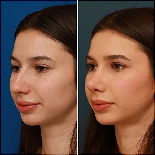 Rhinoplasty Before & After Gallery - Patient 58242488 - Image 6