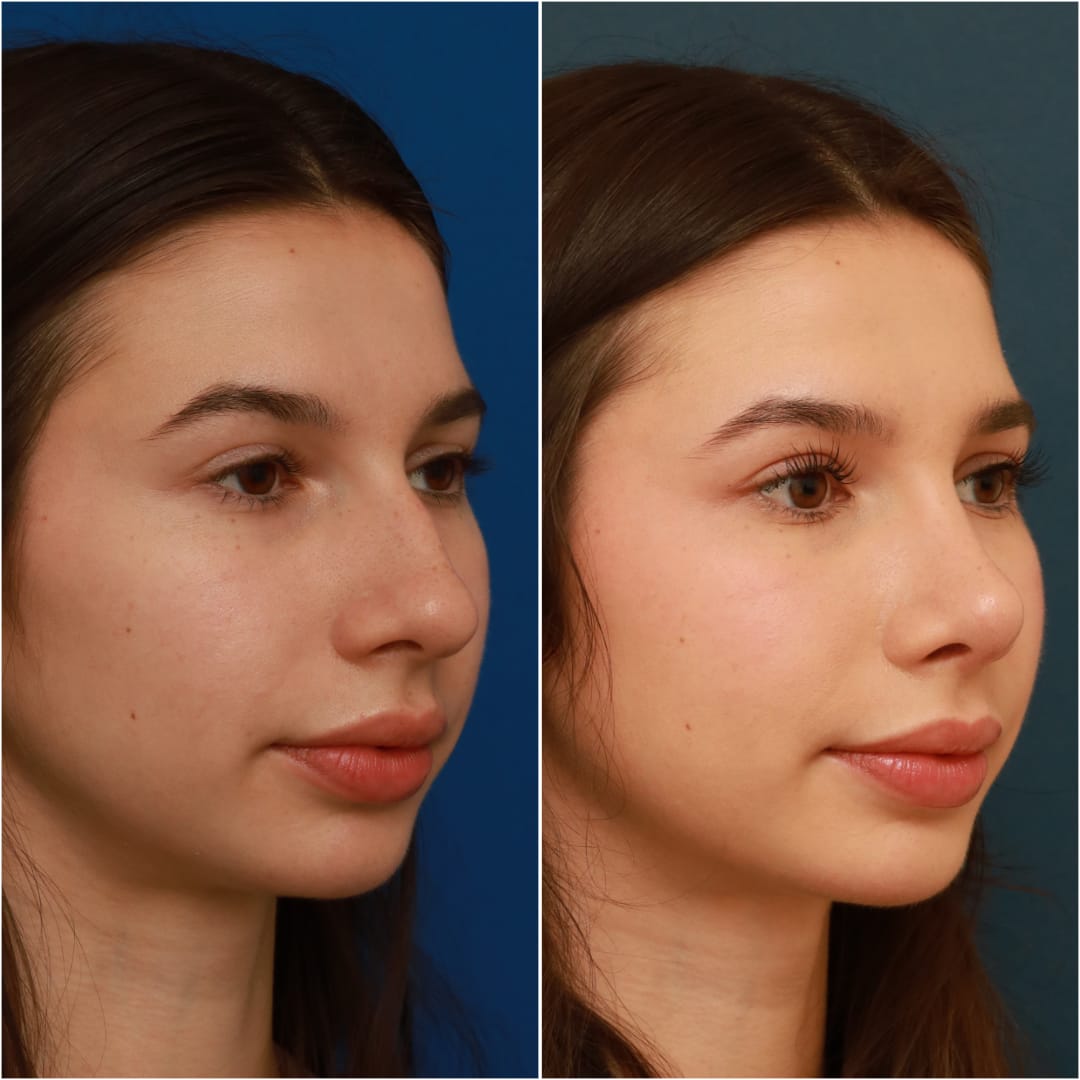 Rhinoplasty Before & After Gallery - Patient 58242488 - Image 7