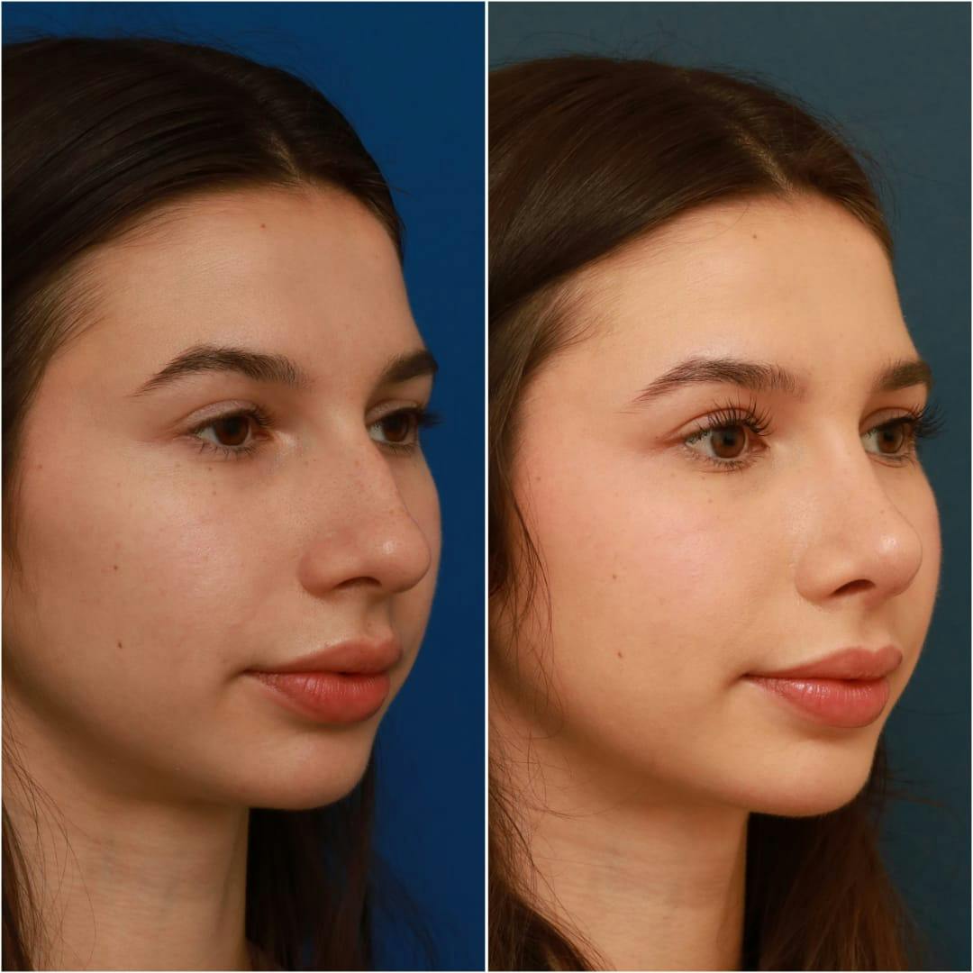 Rhinoplasty Before & After Gallery - Patient 58242488 - Image 7