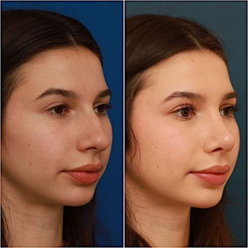 Rhinoplasty Before & After Gallery - Patient 58242488 - Image 7