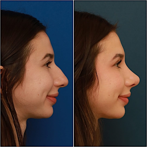 Rhinoplasty Before & After Gallery - Patient 58242488 - Image 8