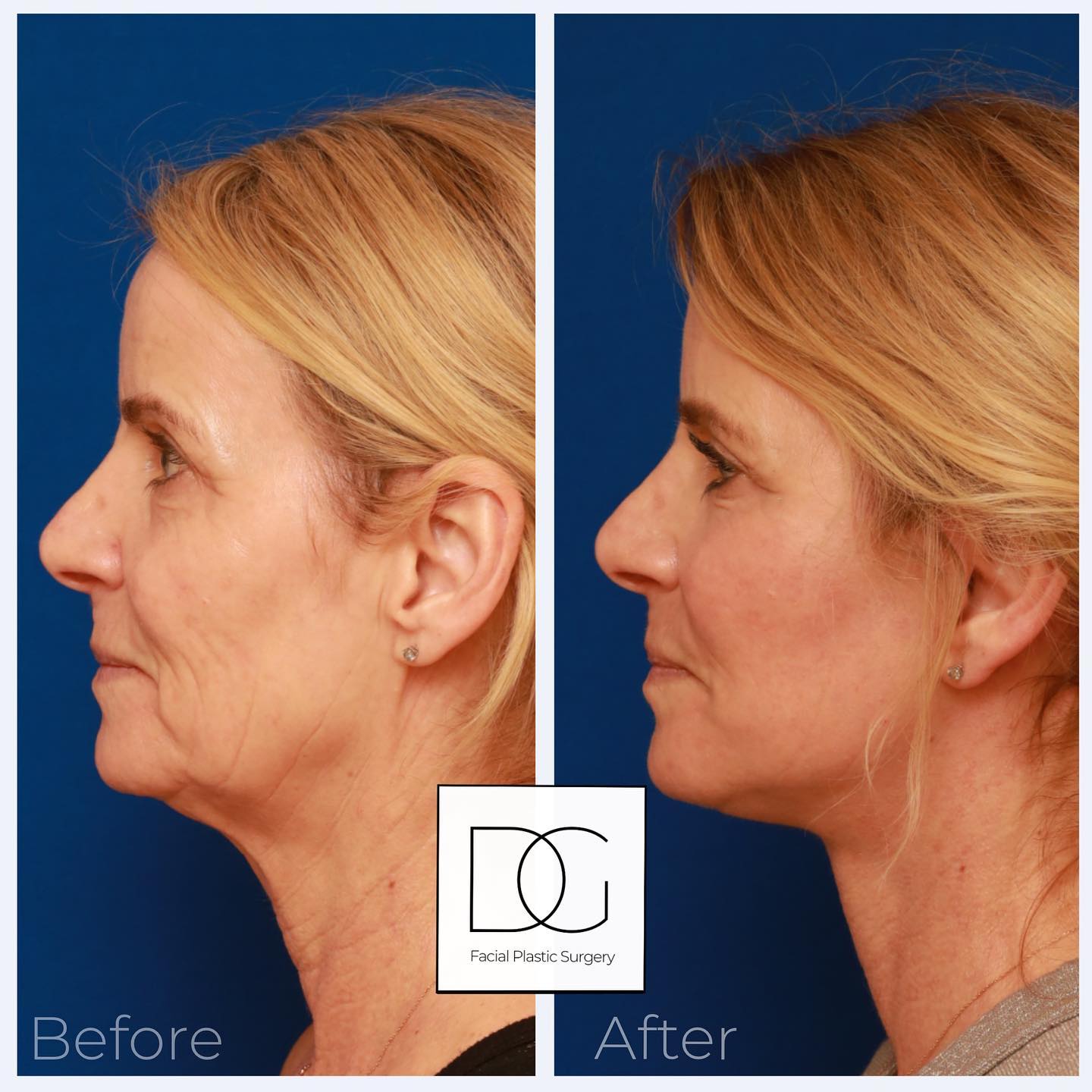 Deep Plane Face & Neck Lift Results Facial Plastic Surgeon Palo