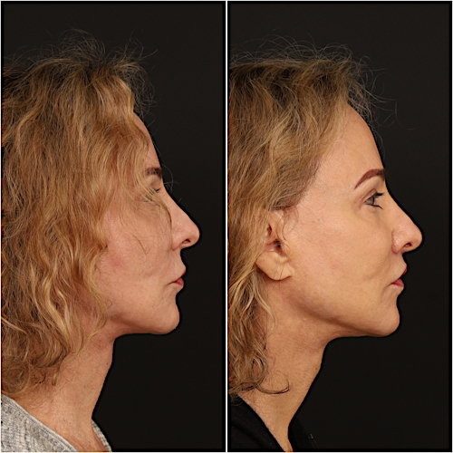 Lip Lift Before & After Gallery - Patient 133276381 - Image 5