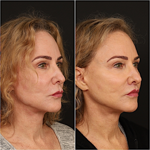 Lip Lift Before & After Gallery - Patient 133276381 - Image 4
