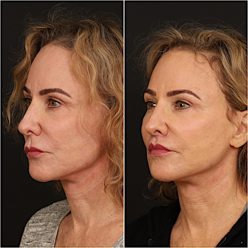 Lip Lift Before & After Gallery - Patient 133276381 - Image 6