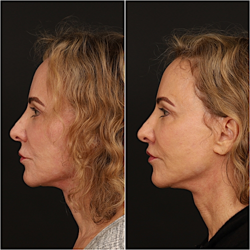 Lip Lift Before & After Gallery - Patient 133276381 - Image 7