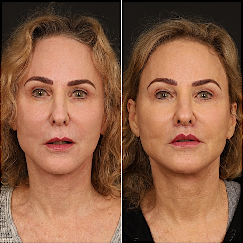 Lip Lift Before & After Gallery - Patient 133276381 - Image 2
