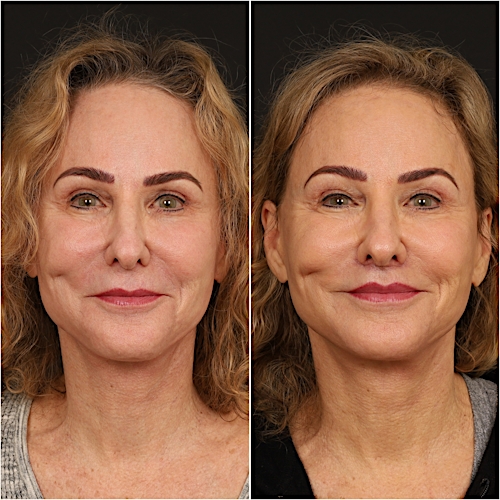 Lip Lift Before & After Gallery - Patient 133276381 - Image 3