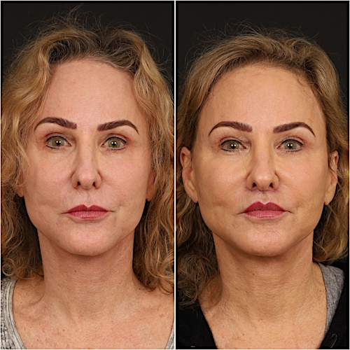 Lip Lift Before & After Gallery - Patient 133276381 - Image 1