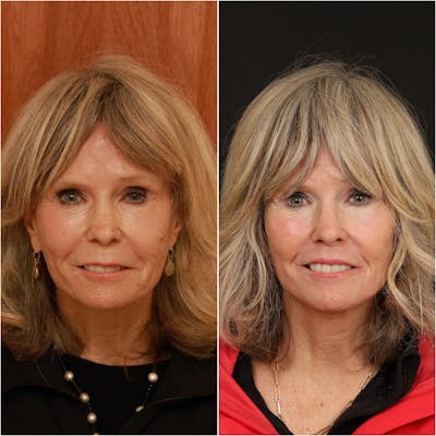 Lip Lift Before & After Gallery - Patient 133276385 - Image 1