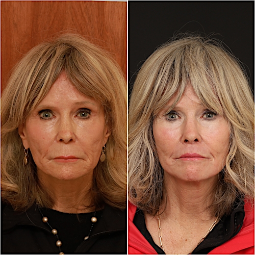 Lip Lift Before & After Gallery - Patient 133276385 - Image 2