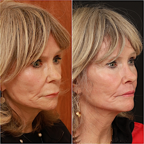 Lip Lift Before & After Gallery - Patient 133276385 - Image 3