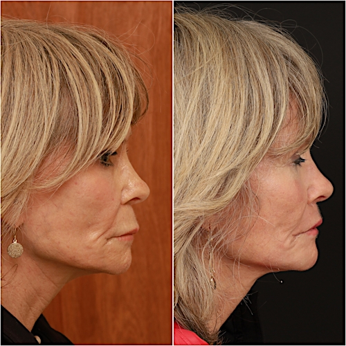 Lip Lift Before & After Gallery - Patient 133276385 - Image 4