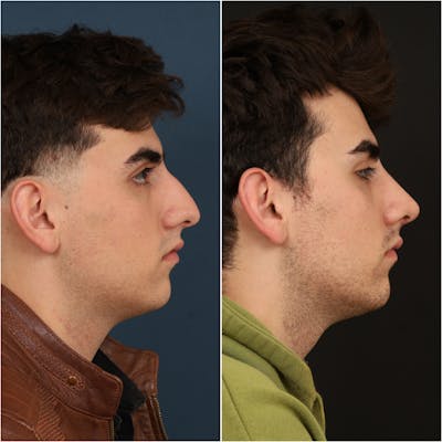 Rhinoplasty Before & After Gallery - Patient 133276397 - Image 1