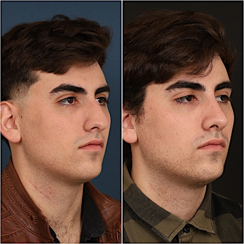 Rhinoplasty Before & After Gallery - Patient 133276397 - Image 2