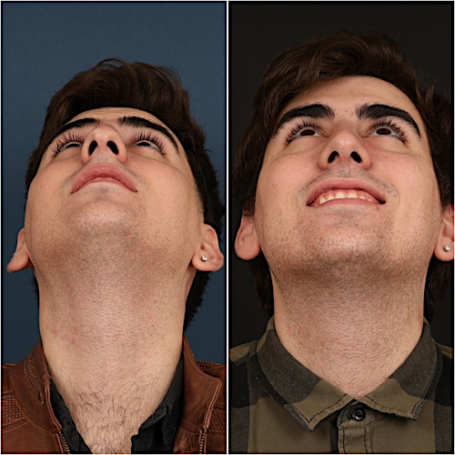 Rhinoplasty Before & After Gallery - Patient 133276397 - Image 5