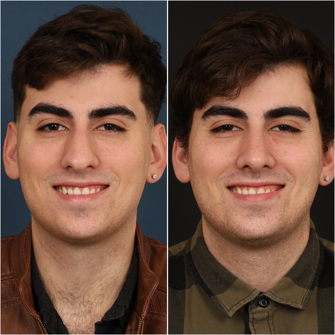 Rhinoplasty Before & After Gallery - Patient 133276397 - Image 4