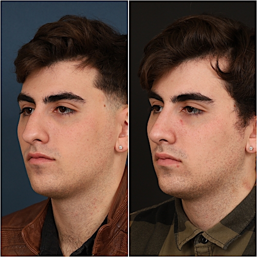 Rhinoplasty Before & After Gallery - Patient 133276397 - Image 6