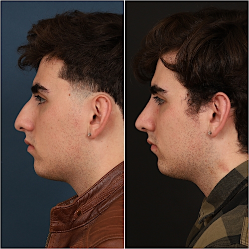 Rhinoplasty Before & After Gallery - Patient 133276397 - Image 7