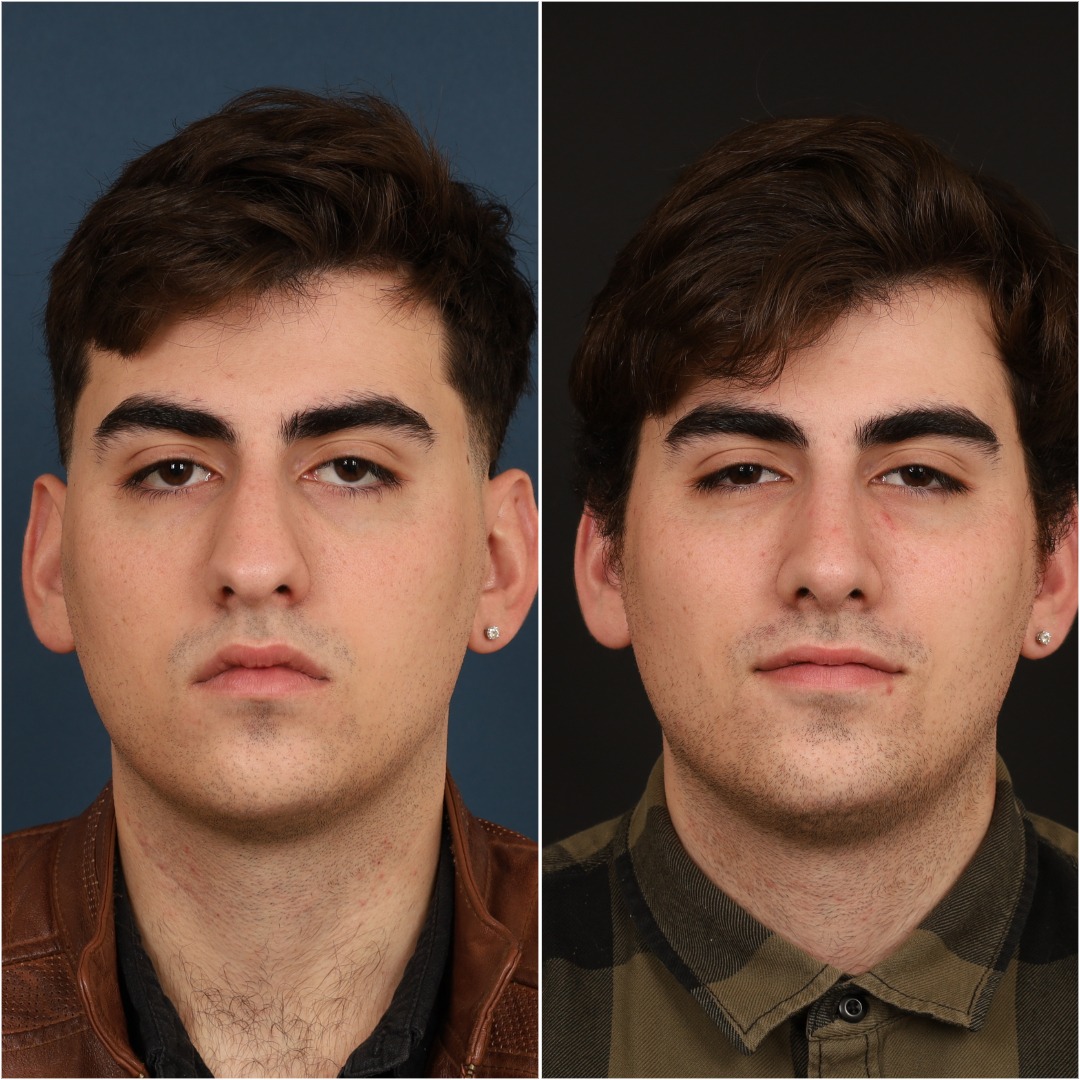 Rhinoplasty Before & After Gallery - Patient 133276397 - Image 3