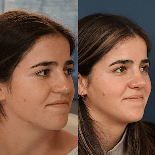 Rhinoplasty Before & After Gallery - Patient 133418545 - Image 2