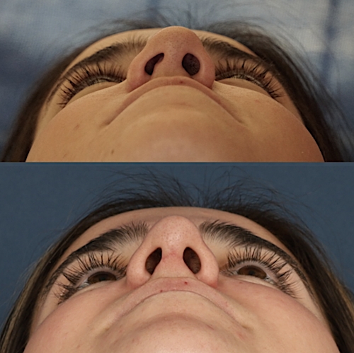 Rhinoplasty Before & After Gallery - Patient 133418545 - Image 4