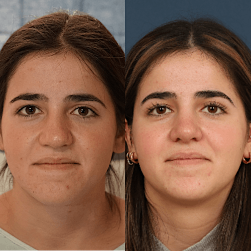 Rhinoplasty Before & After Gallery - Patient 133418545 - Image 3