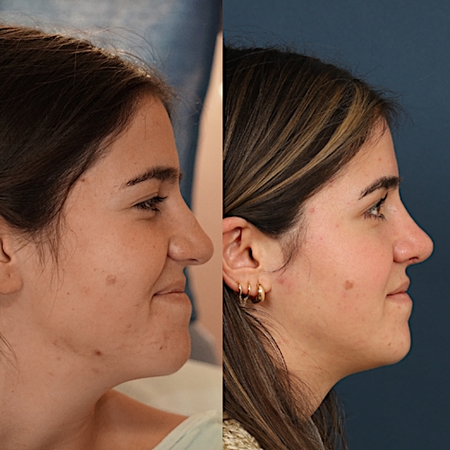 Rhinoplasty Before & After Gallery - Patient 133418545 - Image 1