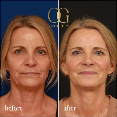 Neck Lift Before & After Gallery - Patient 420377 - Image 1