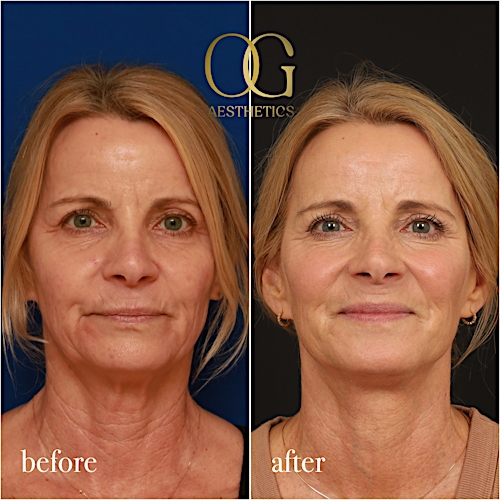 Facelift Before & After Gallery - Patient 190629129 - Image 1