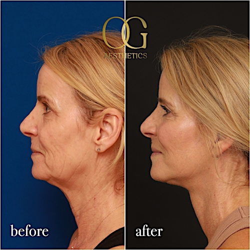 Laser Resurfacing Before & After Gallery - Patient 190629133 - Image 2