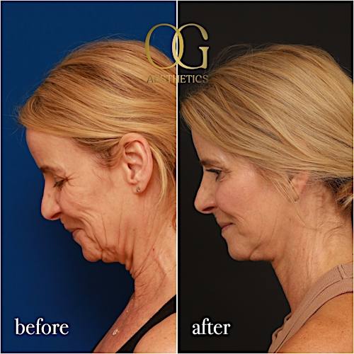 Facelift Before & After Gallery - Patient 190629129 - Image 3