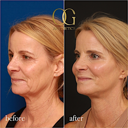 Facelift Before & After Gallery - Patient 190629129 - Image 4