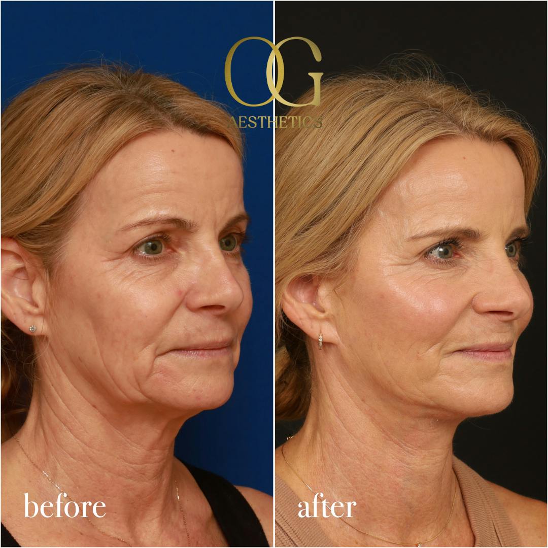 Neck Lift Before & After Gallery - Patient 420377 - Image 5