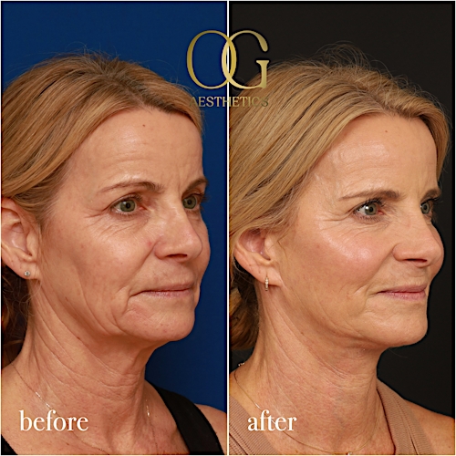 Laser Resurfacing Before & After Gallery - Patient 190629133 - Image 5