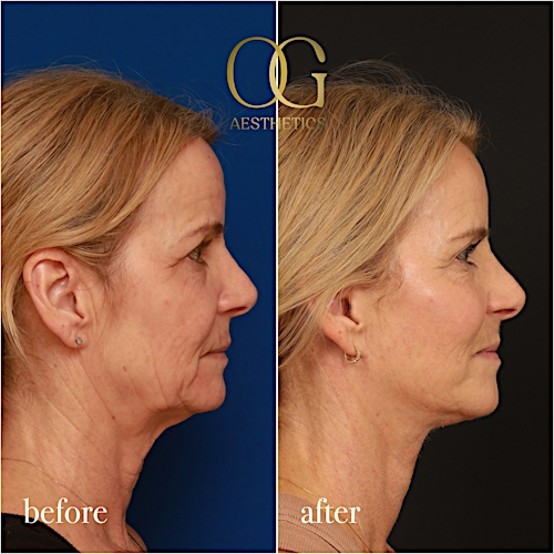Facelift Before & After Gallery - Patient 190629129 - Image 6