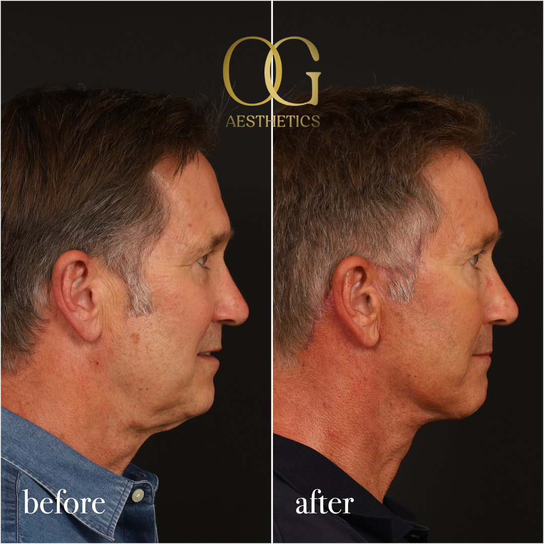 Neck Lift Before & After Gallery - Patient 245267 - Image 4