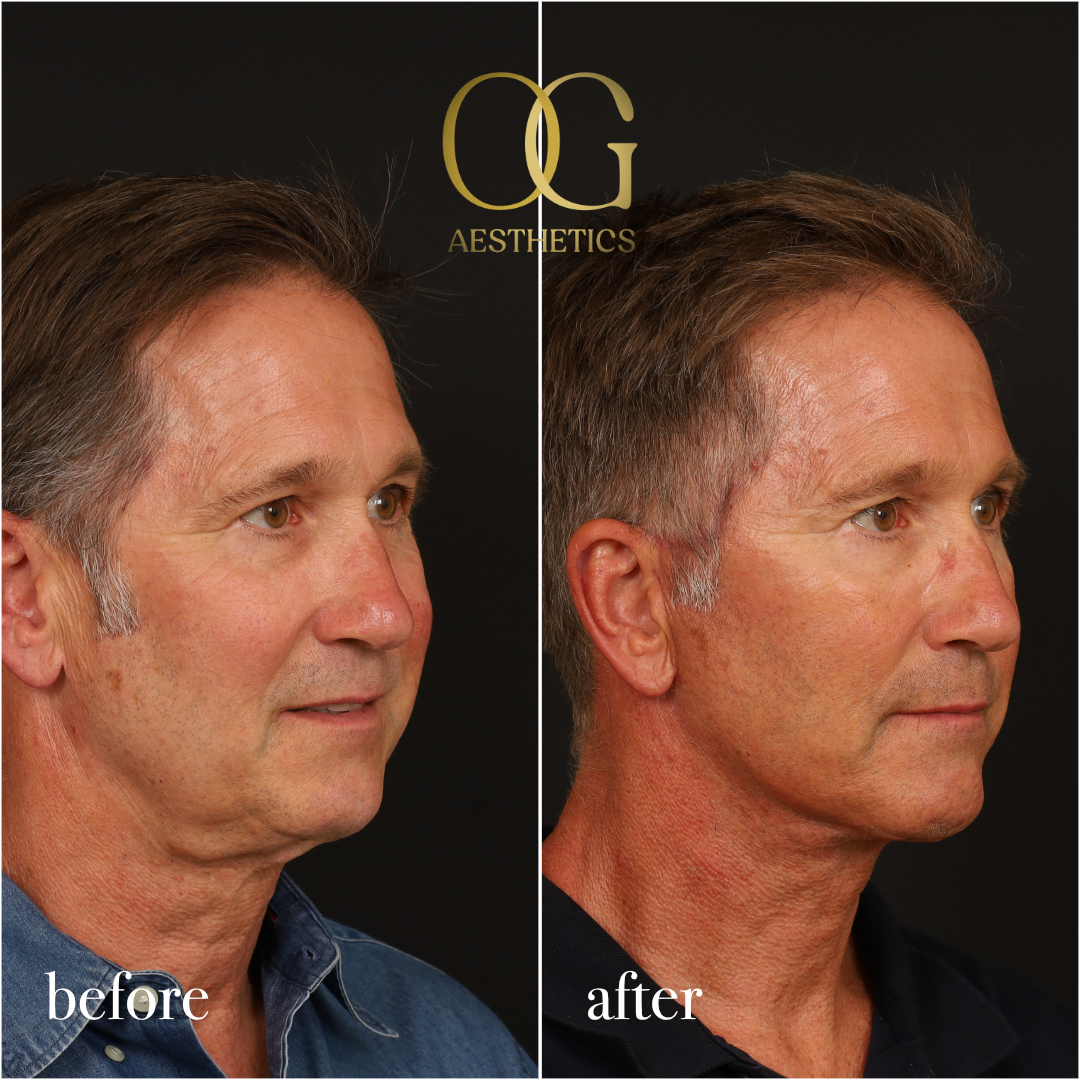 Neck Lift Before & After Gallery - Patient 245267 - Image 3