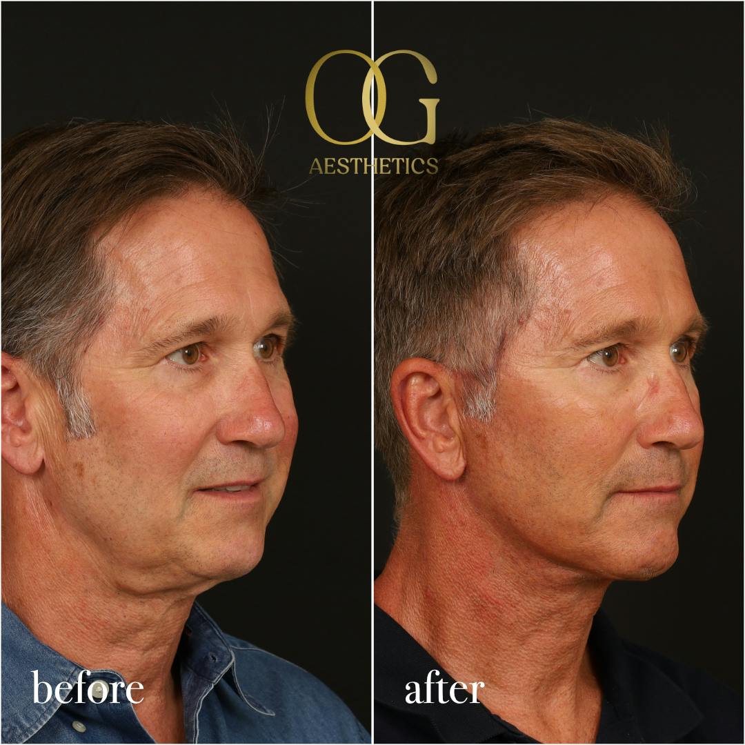 Neck Lift Before & After Gallery - Patient 245267 - Image 3